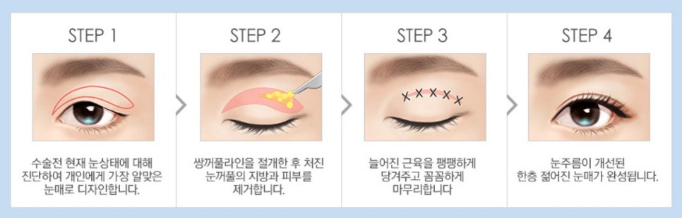 [JWJungwon Plastic Surgery] Erase the Signs of Time with Upper Blepharoplasty! image 6