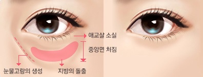 중년남성도 받는다는 하안검수술은▶ JW정원성형외과!! 관련 이미지 2