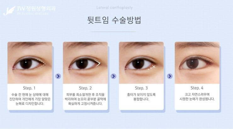 [JW정원성형외과] 시원한 눈매를 완성해주는 트임성형, 트임성형 잘하는 곳에서! 관련 이미지 8