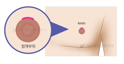 남모를 고민 여성형유방(여유증), JW정원성형외과 여성형유방 수술로 고민해결! 관련 이미지 2