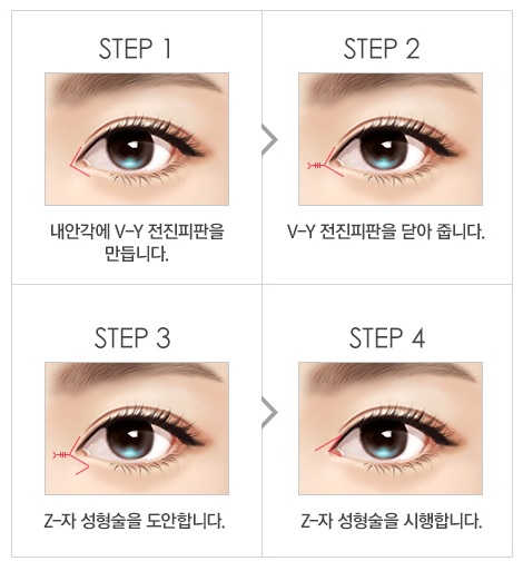 [눈재수술] 트임 복원술도 역시 JW정원성형외과! 관련 이미지 3