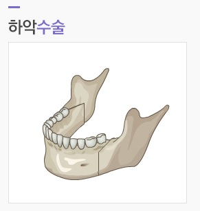 매끈한 얼굴라인과 턱기능 개선을 동시에! JW정원성형외과 주걱턱성형 관련 이미지 3