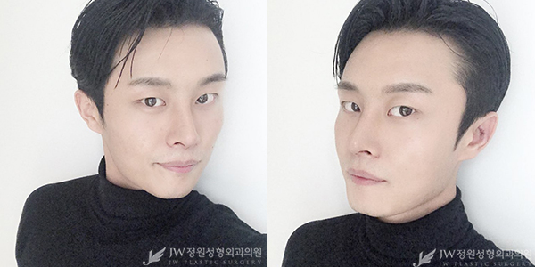 눈+코 성형으로 남성적인 이미지 UP 남자성형도 역시 JW정원성형외과! 관련 이미지 2