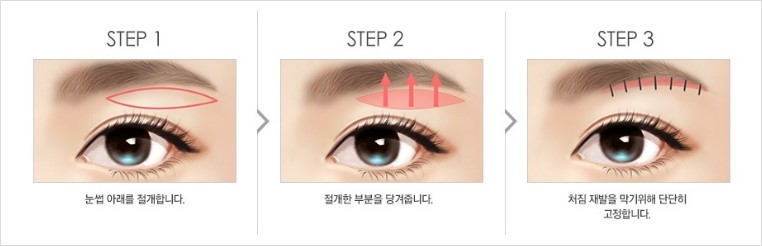 [JW정원성형외과] 처진 눈꺼풀 늘어진 지방과 주름 제거 상안검 수술로 해결 관련 이미지 4