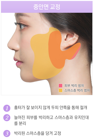 뼈 수술 없이 매끄러운 브이라인얼굴! JW정원성형외과 윤곽교정 관련 이미지 4