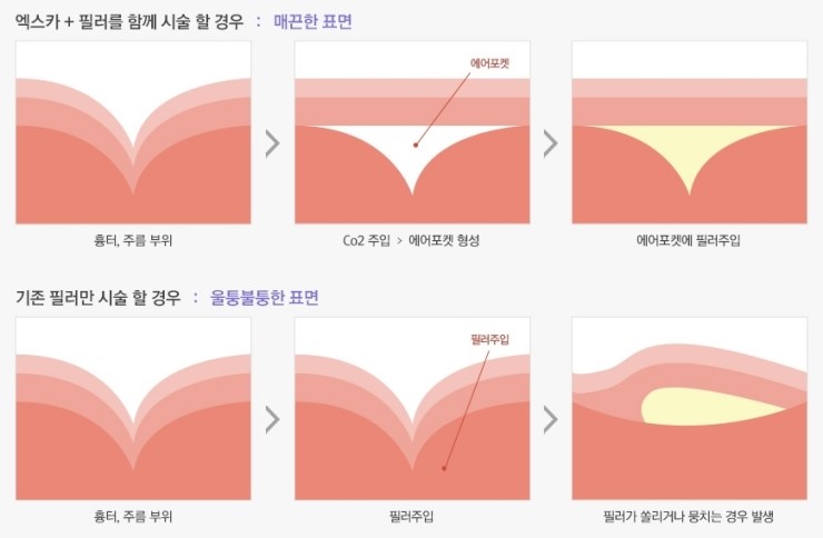 흉터? 주름? JW정원성형외과 엑스카로 말끔하게! 관련 이미지 3