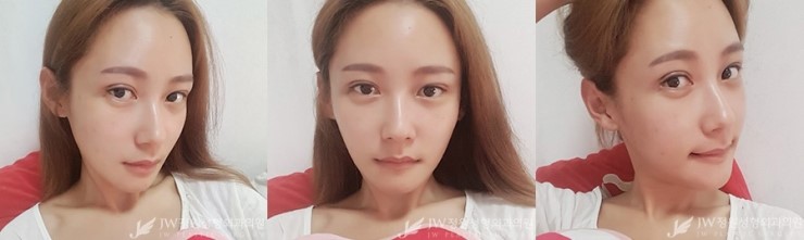 [JW정원성형외과] 턱끝재수술, 비절개눈매교정으로 동안 완성♡ 리얼셀카 관련 이미지 2