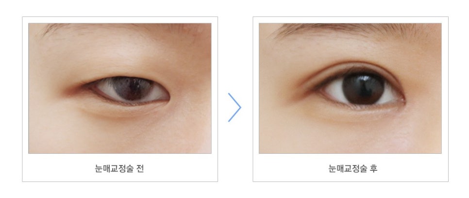 절개/비절개눈매교정, 나에게 맞는 눈매교정술은? 관련 이미지 2