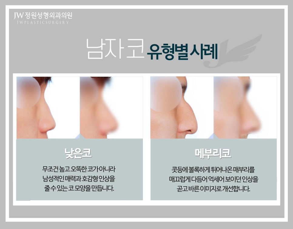JW Male Rhinoplasty for a Refined Straight Line image 4