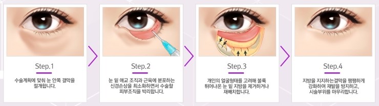 [JW정원성형외과] 눈밑지방재배치 핵심 기술력 관련 이미지 7