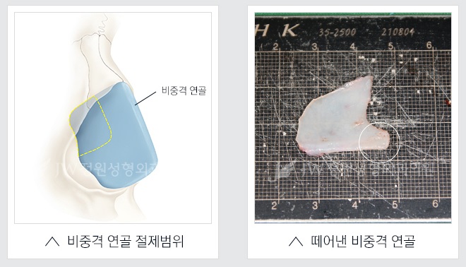 [JW정원성형외과] 코성형, 어려울수록 자신 있습니다! 관련 이미지 17