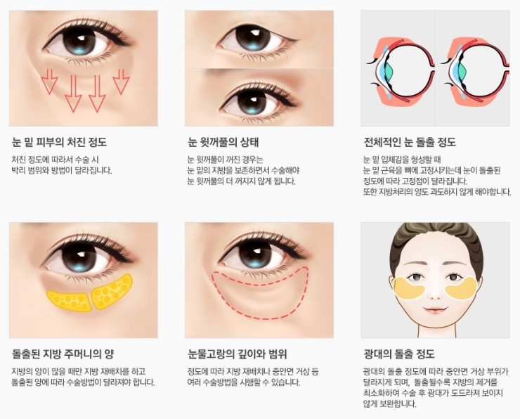 환한 눈매와 동안 얼굴을 동시에, JW정원성형외과 REWIND 하안검 관련 이미지 5