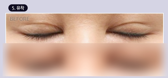 Double Eyelid Line Revision Surgery: Finding a Clinic That Is Good at Eye Revision Surgery image 6