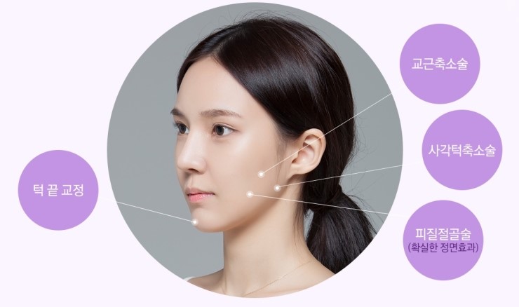 각진 얼굴 NO! JW정원성형외과 브이라인 성형으로 작고 갸름한 얼굴 완성 관련 이미지 2