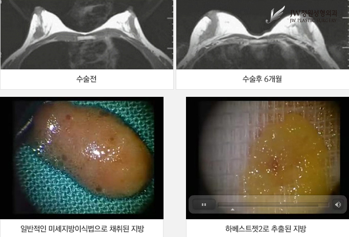군살은 빼고 자연스러운 가슴확대로 예뻐지는 하베스트젯2 관련 이미지 2