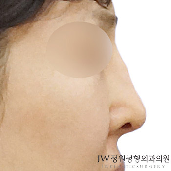 Hump Nose Correction for a Smooth Line Without Recurrence image 1