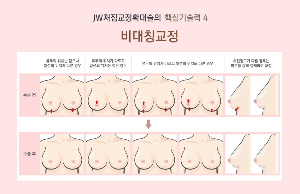 처진정도, 높이, 위치, 비대칭 등을 고려한 JW 처진가슴수술 관련 이미지 7