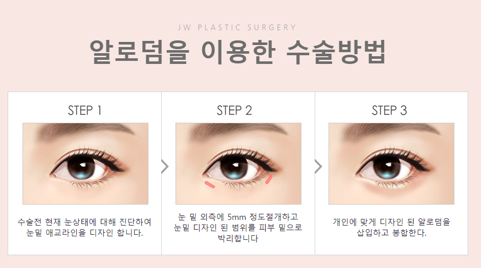 정원 눈밑애교살수술, 눈밑 볼륨을 채워 생기있고 귀엽게! 관련 이미지 2
