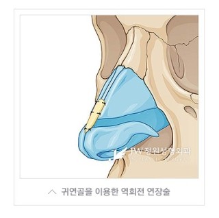 내 얼굴의 중심, 황금비율로! JW정원성형외과 짧은코성형 관련 이미지 4