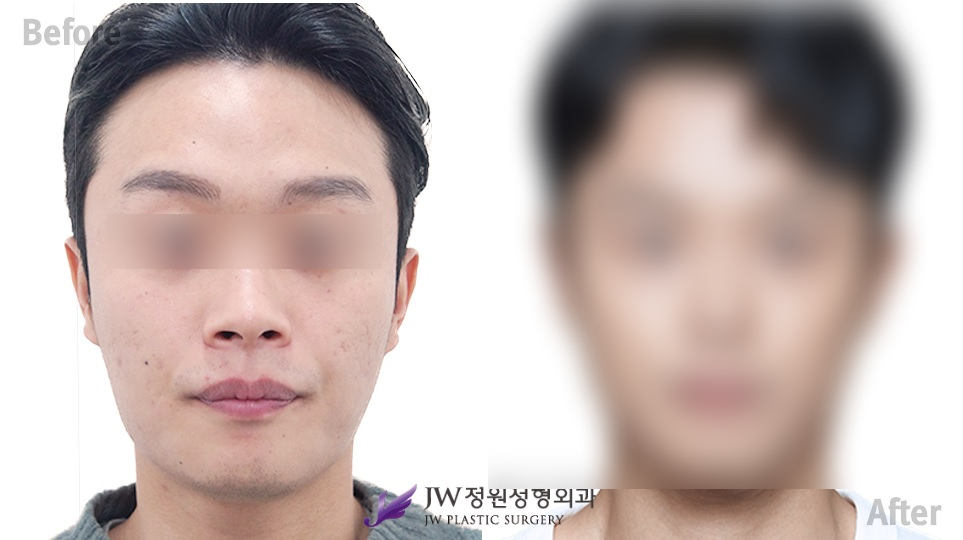 무보형물 복코성형, 콧볼축소수술후 자신감 뿜뿜 관련 이미지 2