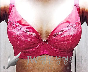 JW정원성형외과 모티바가슴성형 내몸에 꼭 맞는 선택 관련 이미지 4