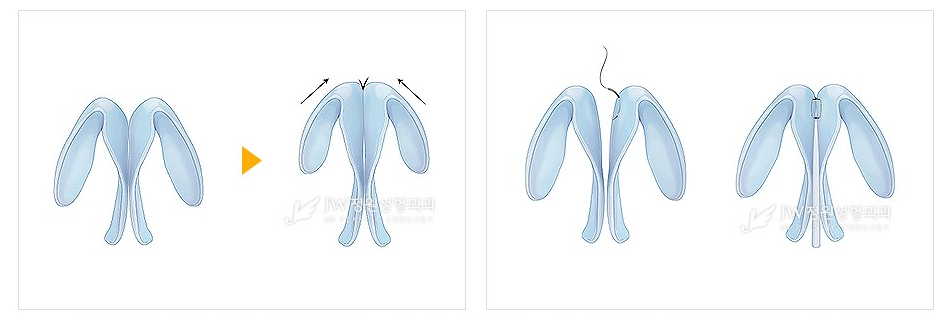 무보형물 복코성형, 콧볼축소수술후 자신감 뿜뿜 관련 이미지 7