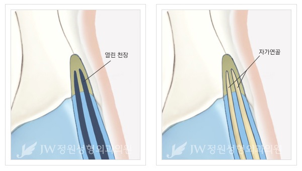 날렵하고 부드러운 이미지로! JW정원성형외과 매부리코성형 관련 이미지 4