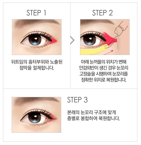 [눈재수술] 트임 복원술도 역시 JW정원성형외과! 관련 이미지 4