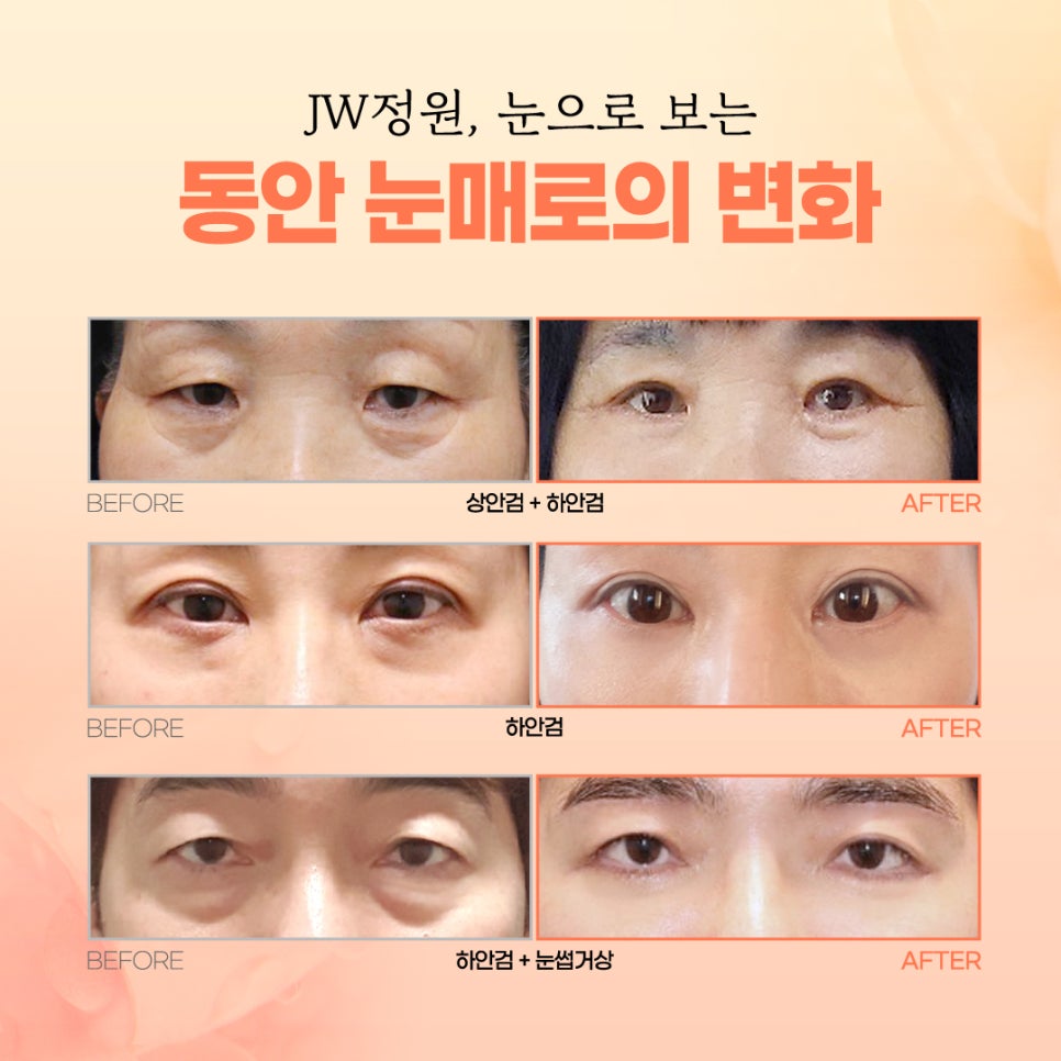 Mother’s Day Event: A Second Spring for Your Parents 【Gangnam JW Jeongwon Plastic Surgery】 image 3