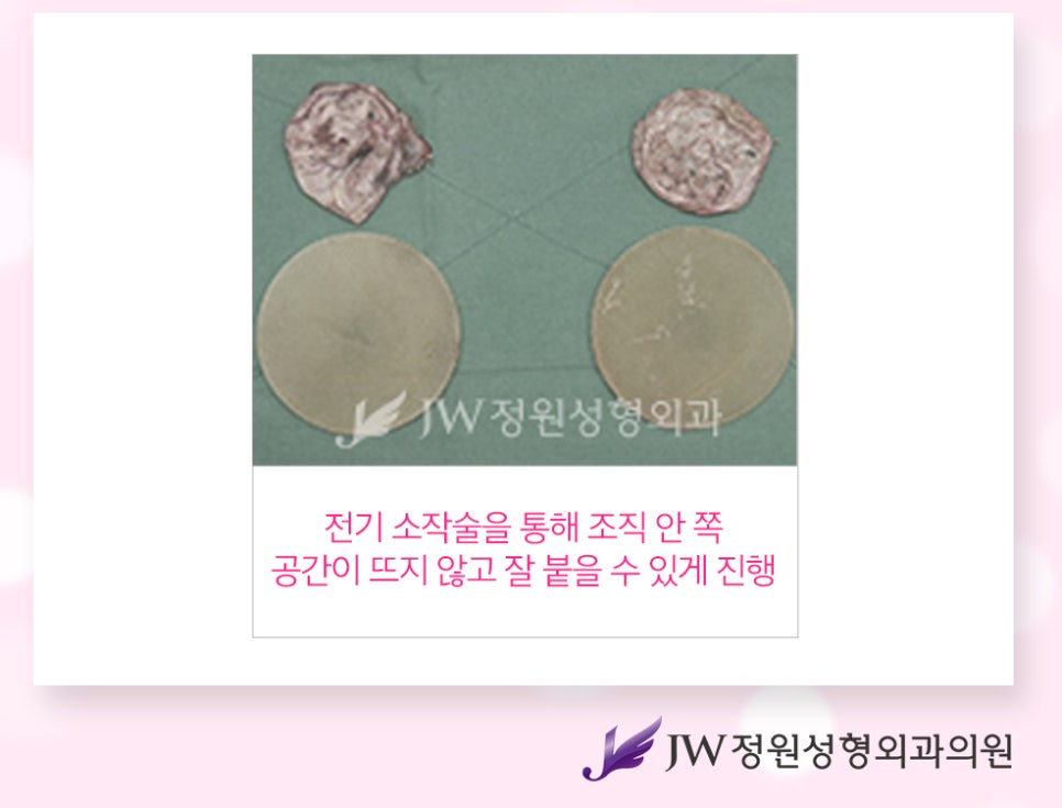 가슴재수술잘하는곳, 원인에 맞는 수술방법으로 자연스럽게 관련 이미지 3