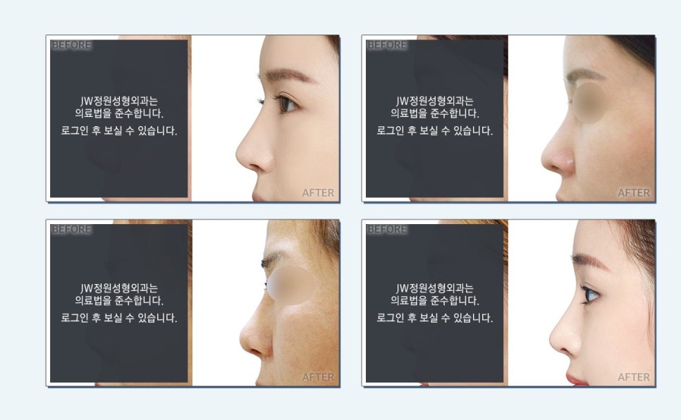 자연스럽게 움직이는 코끝, 처짐없는 코끝성형수술 알아봐요 관련 이미지 2