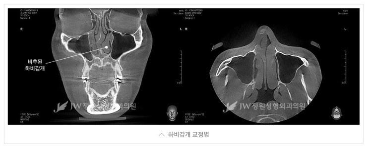 기능성과 심미성을 한번에! JW정원성형외과 휜코 교정 관련 이미지 5