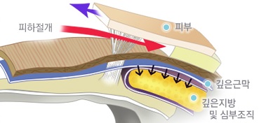 JW정원성형외과 안면거상술▶ 스마스조각리프팅이란? 관련 이미지 6