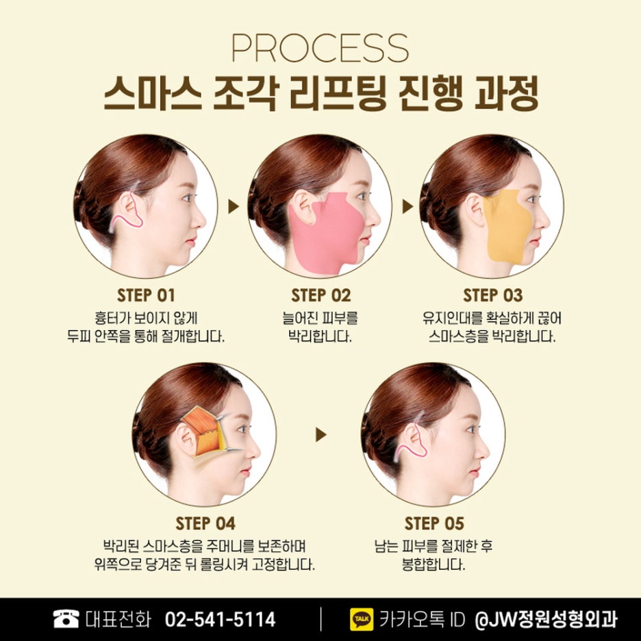 Facelift Surgery Cost: Softening Deep Wrinkles image 3