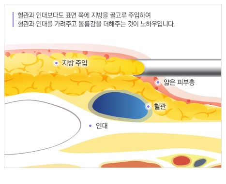 감출 수 없는 세월의 흔적, JW정원성형외과 손등지방이식으로 말끔하게! 관련 이미지 2