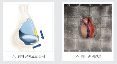 Nose Revision Surgery and Tip Plasty for a Soft, Flexible Pig Nose Look! image 7