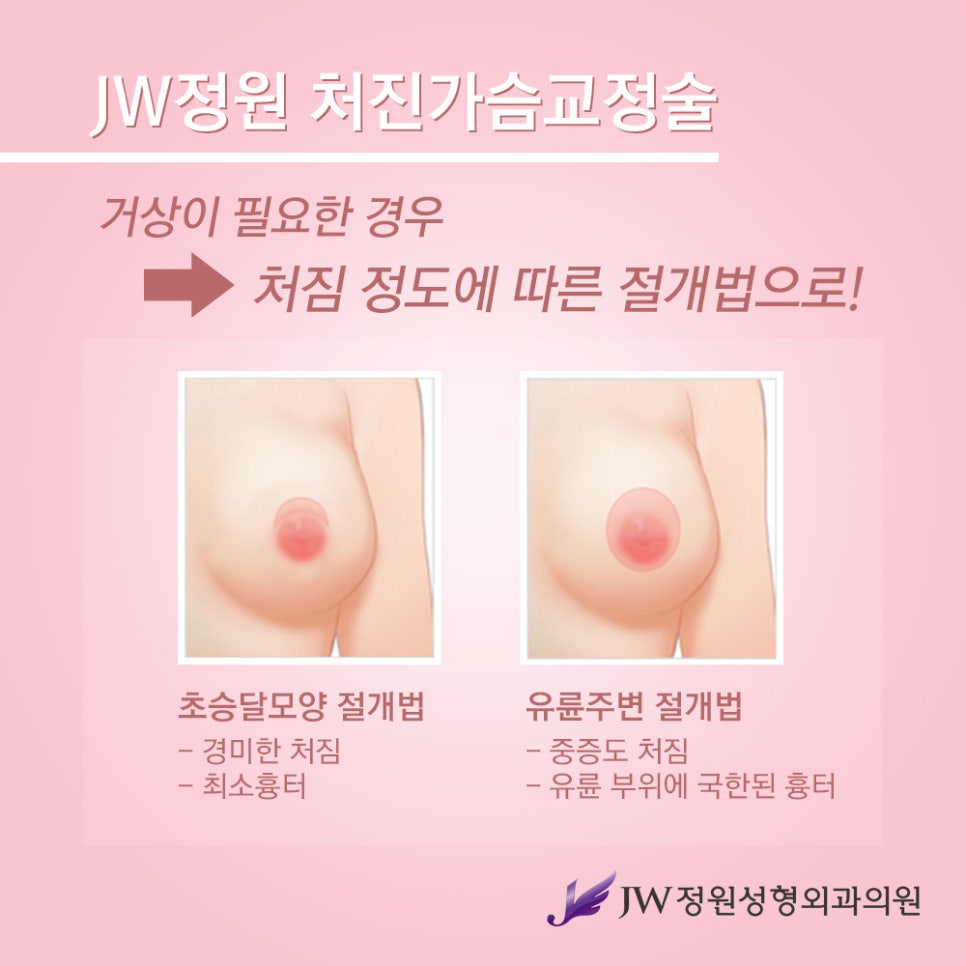 [JW정원성형외과] 처진가슴교정으로 자신감 회복! 관련 이미지 6