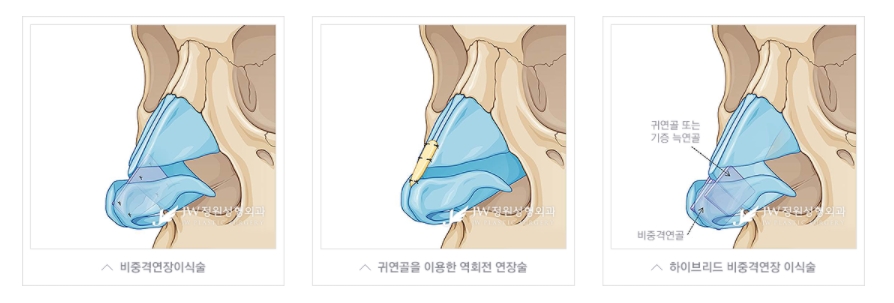 들창코수술 짧은코수술 [화려한 라인/자연스러운 라인] 내가 원하는 라인으로! 관련 이미지 5