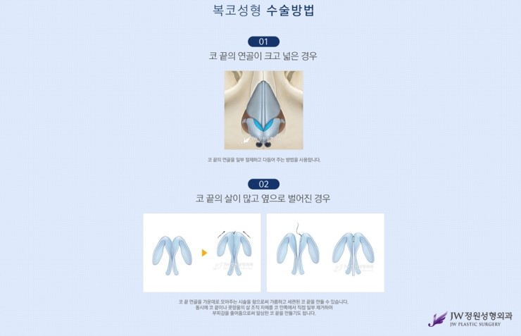 [JW정원성형외과] 촌스러운 이미지를 복코교정으로 세련되게! 콧볼축소잘하는곳에서 알아봐요 관련 이미지 7