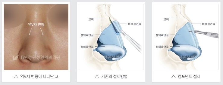[JW정원성형외과] 코성형, 어려울수록 자신 있습니다! 관련 이미지 13
