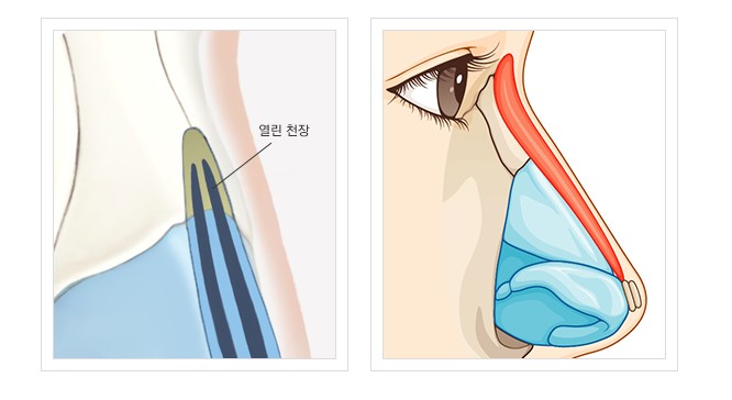 Hump Nose Diagnosis, for a More Natural Appearance image 3