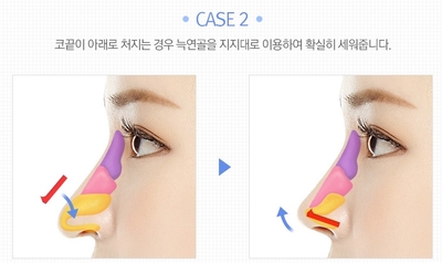 [JW Jeongwon Plastic Surgery] More Professional and Safer Rib Cartilage Rhinoplasty image 5