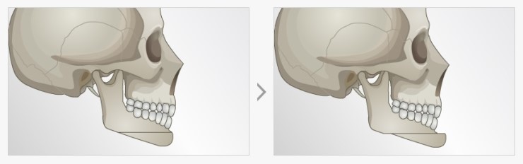 밋밋한 턱끝 NO! JW정원성형외과 무턱성형으로 세련된 얼굴라인 완성! 관련 이미지 3