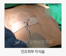 안전함과 아름다움을 동시에! JW정원성형외과 가슴재수술 관련 이미지 4