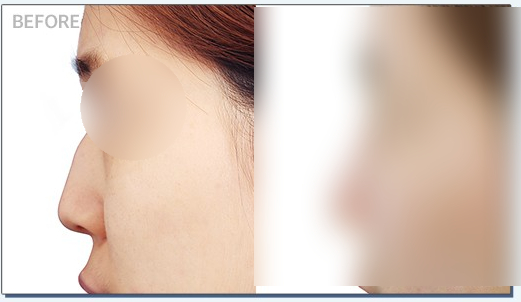 Hump Nose Correction for a Smooth Line Without Recurrence image 2