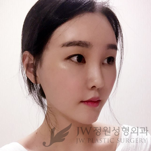 이마눈썹리프팅,눈매교정술,앞트임복원,코성형,지방이식 ⇒ JW정원성형외과에서! 관련 이미지 4
