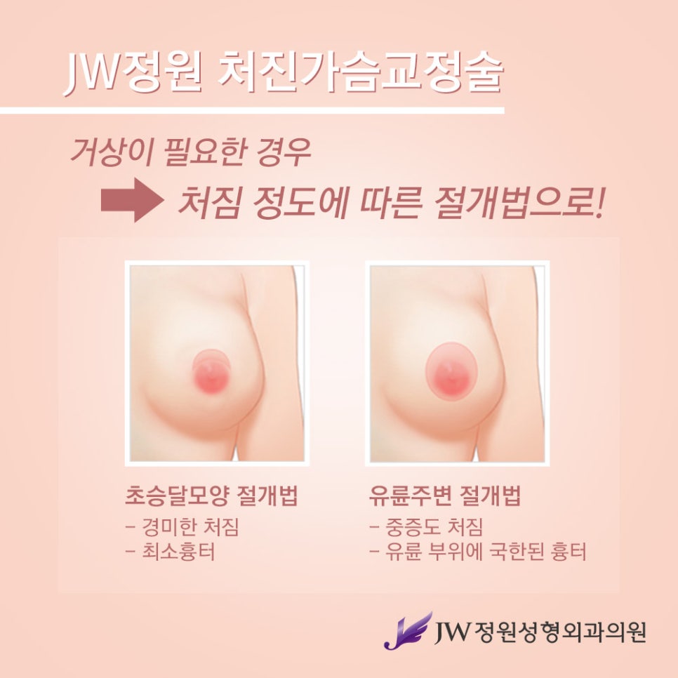 Breast Lift Surgery for Drooping Breasts, with a Natural and Firm Result image 6