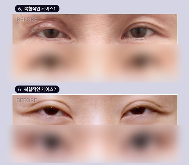 Double Eyelid Line Revision Surgery: Finding a Clinic That Is Good at Eye Revision Surgery image 7