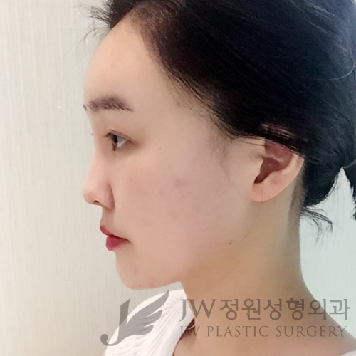이마눈썹리프팅,눈매교정술,앞트임복원,코성형,지방이식 ⇒ JW정원성형외과에서! 관련 이미지 7