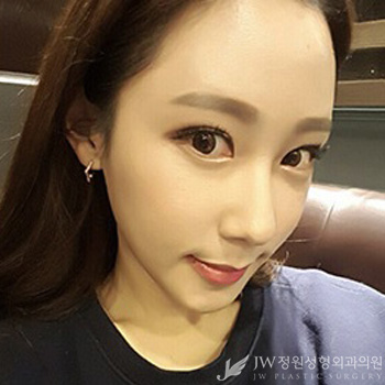 [JW정원성형외과] 턱끝재수술, 비절개눈매교정으로 동안 완성♡ 리얼셀카 관련 이미지 6